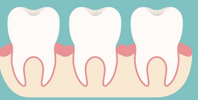 你为什么会牙龈萎缩 重庆牙科医院